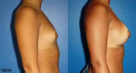 Patient 10843, Breast Augmentation Before and After Photos Breast Augmentation Before and After Photos in New York, NY, Patient 10843
