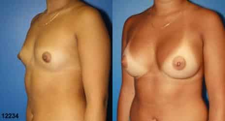 Patient 10843, Breast Augmentation Before and After Photos Breast Augmentation Before and After Photos in New York, NY, Patient 10843