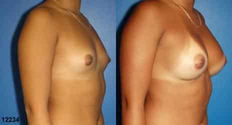 Patient 10843, Breast Augmentation Before and After Photos Breast Augmentation Before and After Photos in New York, NY, Patient 10843