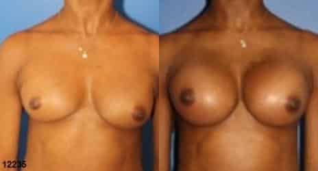 Breast Augmentation Before and After Photos in New York, NY, Patient 10849