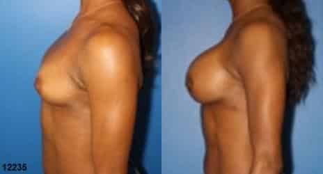 Breast Augmentation Before and After Photos in New York, NY, Patient 10849