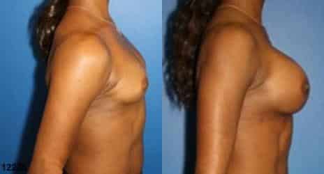 Breast Augmentation Before and After Photos in New York, NY, Patient 10849