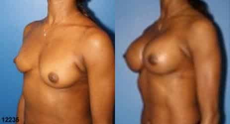 Breast Augmentation Before and After Photos in New York, NY, Patient 10849