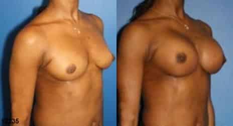 Breast Augmentation Before and After Photos in New York, NY, Patient 10849