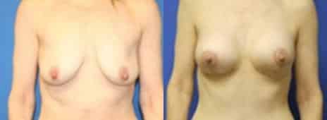 Breast Lift Before and After Photos in New York, NY, Patient 10890