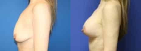 Breast Lift Before and After Photos in New York, NY, Patient 10890