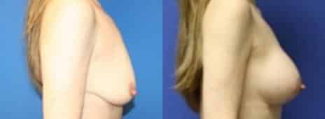 Breast Lift Before and After Photos in New York, NY, Patient 10890