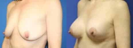 Breast Lift Before and After Photos in New York, NY, Patient 10890