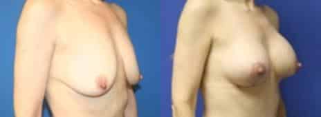 Breast Lift Before and After Photos in New York, NY, Patient 10890