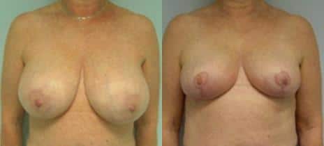 Breast Lift Before and After Photos in New York, NY, Patient 10957