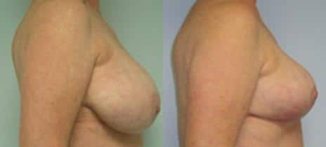 Breast Lift Before and After Photos in New York, NY, Patient 10957