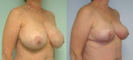 Breast Lift Before and After Photos in New York, NY, Patient 10957