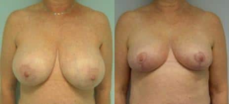 Breast Reduction Before and After Photos in New York, NY, Patient 10981