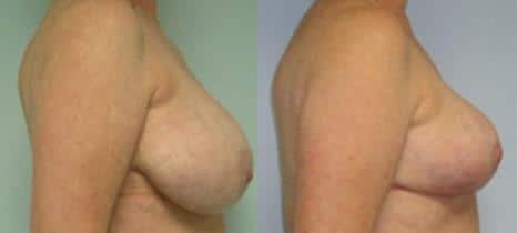 Breast Reduction Before and After Photos in New York, NY, Patient 10981