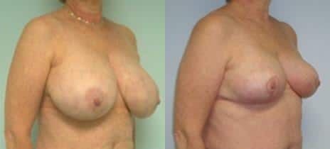 Breast Reduction Before and After Photos in New York, NY, Patient 10981