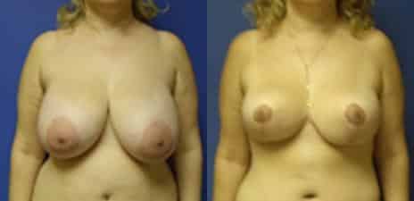 Breast Reduction Before and After Photos in New York, NY, Patient 11005