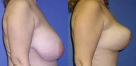 Breast Reduction Before and After Photos in New York, NY, Patient 11005