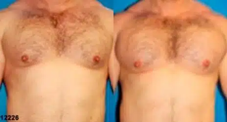 Pectoral Augmentation Before and After Photos in New York, NY, Patient 11123