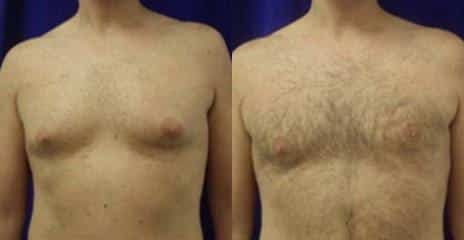 Gynecomastia Before and After Photos in New York, NY, Patient 11129