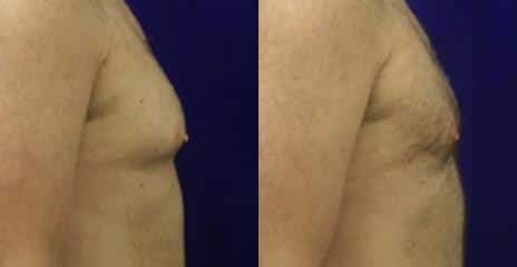 Gynecomastia Before and After Photos in New York, NY, Patient 11129