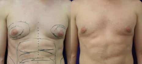 Gynecomastia Before and After Photos in New York, NY, Patient 11173