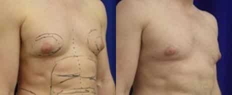 Gynecomastia Before and After Photos in New York, NY, Patient 11173