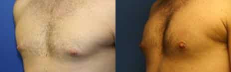 Gynecomastia Before and After Photos in New York, NY, Patient 11177