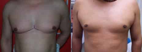 Gynecomastia Before and After Photos in New York, NY, Patient 11180