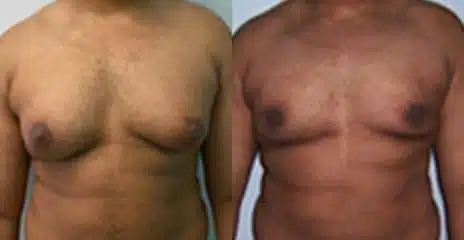 Gynecomastia Before and After Photos in New York, NY, Patient 11182