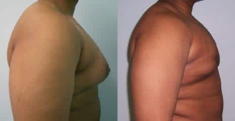 Gynecomastia Before and After Photos in New York, NY, Patient 11182