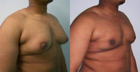 Gynecomastia Before and After Photos in New York, NY, Patient 11182