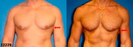 Gynecomastia Before and After Photos in New York, NY, Patient 11186