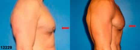 Gynecomastia Before and After Photos in New York, NY, Patient 11186