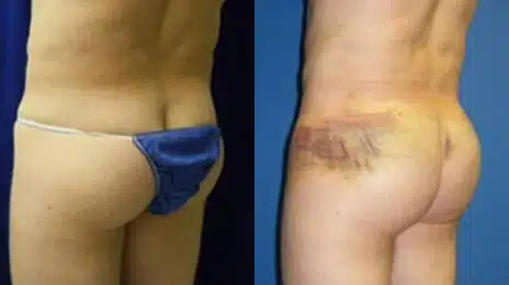 Gluteal Augmentation Before and After Photos in New York, NY, Patient 11224