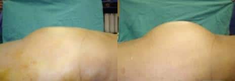 Gluteal Augmentation Before and After Photos in New York, NY, Patient 11226