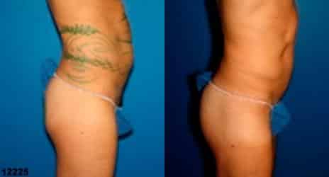 Patient 11228, Gluteal Augmentation Before and After Photos Gluteal Augmentation Before and After Photos in New York, NY, Patient 11228