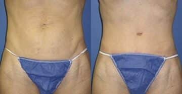Specialized Tummy Tuck Repair Before and After Photos in New York, NY, Patient 11234