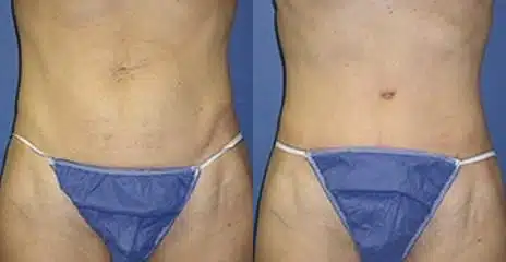 Specialized Tummy Tuck Repair Before and After Photos in New York, NY, Patient 11234