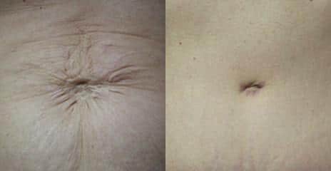 Specialized Tummy Tuck Repair Before and After Photos in New York, NY, Patient 11234