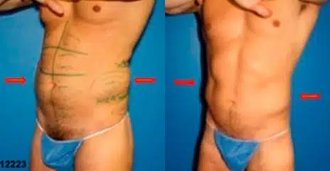 Hi-Def Liposuction Before and After Photos in New York, NY, Patient 11243