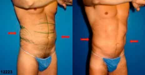 Hi-Def Liposuction Before and After Photos in New York, NY, Patient 11243