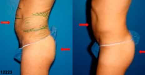 Hi-Def Liposuction Before and After Photos in New York, NY, Patient 11243