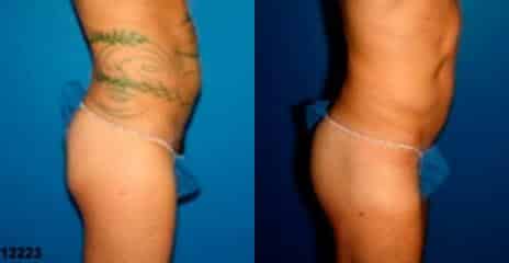 Hi-Def Liposuction Before and After Photos in New York, NY, Patient 11243