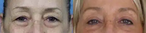 Brow Lift Before and After Photos in New York, NY, Patient 11358