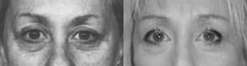Brow Lift Before and After Photos in New York, NY, Patient 11370