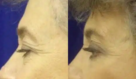 Brow Lift Before and After Photos in New York, NY, Patient 11374