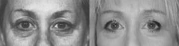 Eyelid Surgery Before and After Photos in New York, NY, Patient 11399