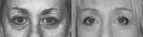 Eyelid Surgery Before and After Photos in New York, NY, Patient 11399