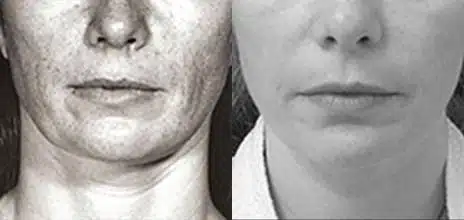 Chin Implant Before and After Photos in New York, NY, Patient 11415