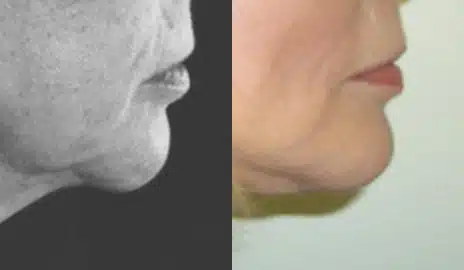 Chin Implant Before and After Photos in New York, NY, Patient 11426